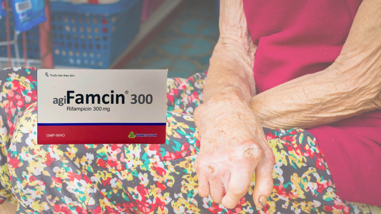 Agifamcin 300 chuyên dùng phối hợp điều trị bệnh phong