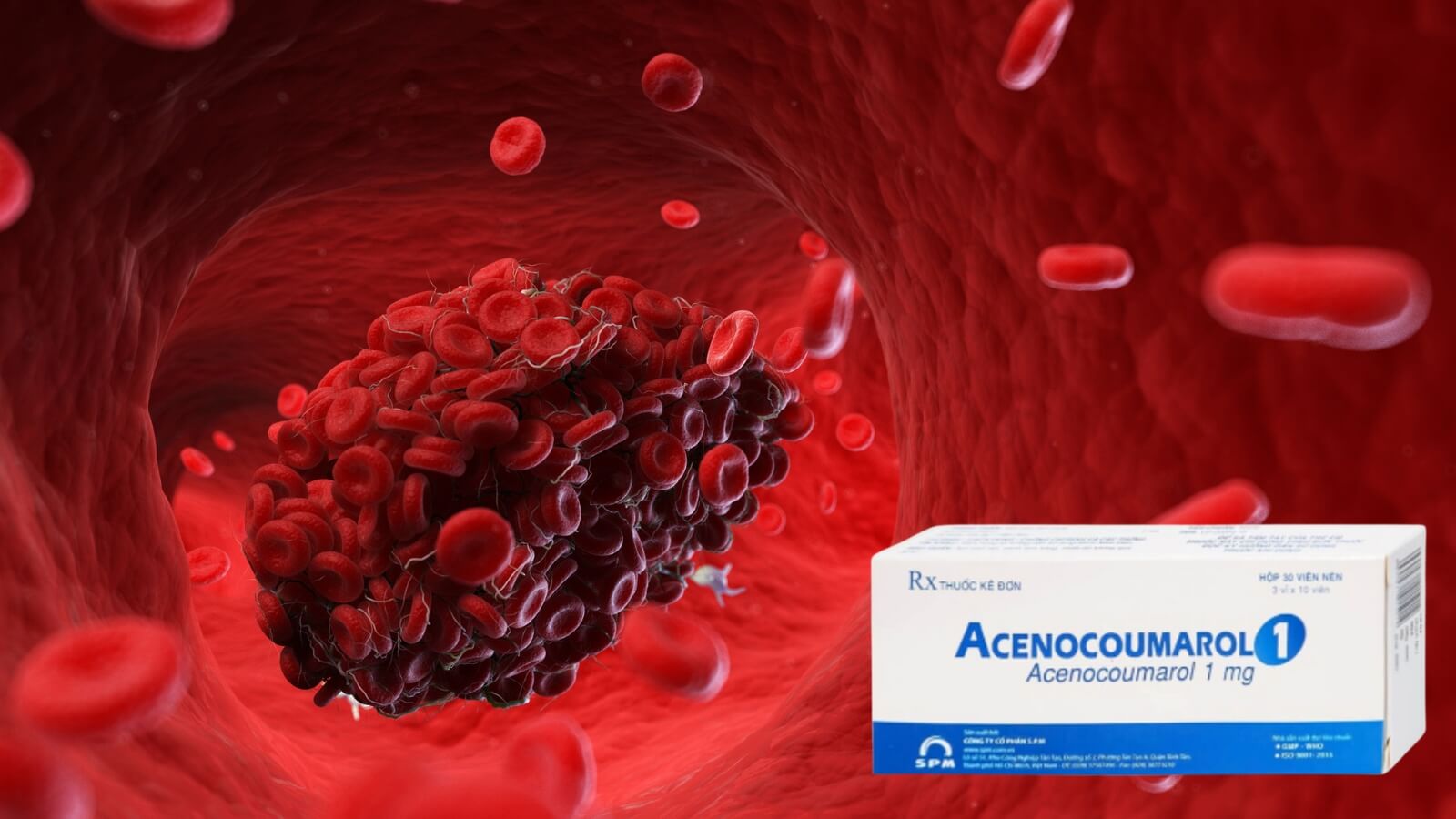 Thuốc Acenocoumarol 1mg chứa Acenocoumarol giúp chống đông máu