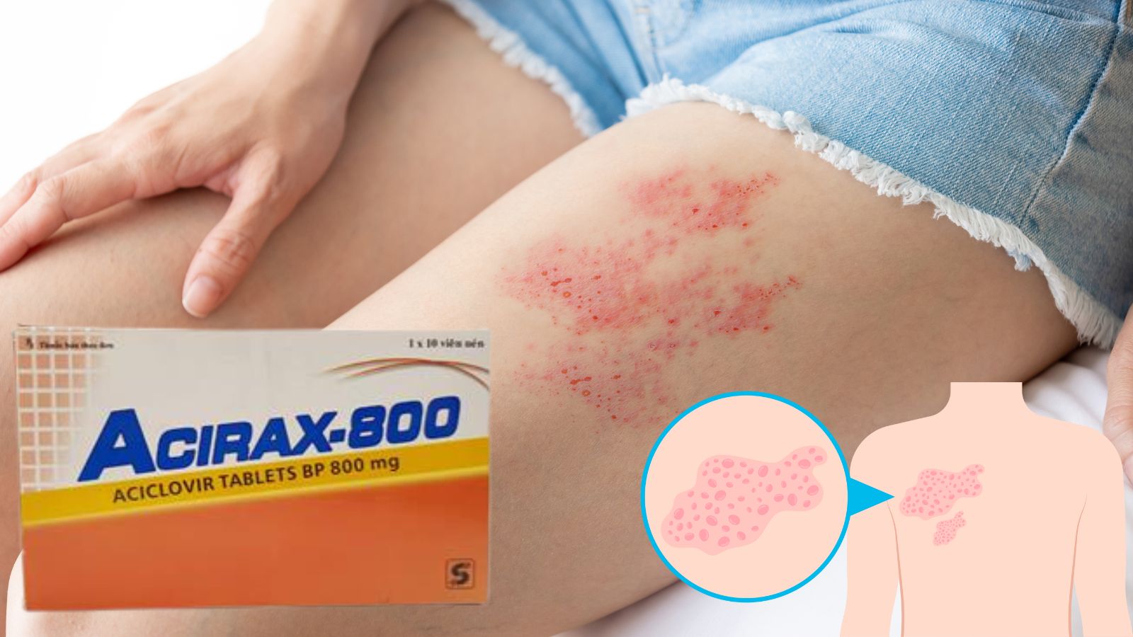 Thuốc Acirax-800 điều trị các bệnh do virus herpes gây ra