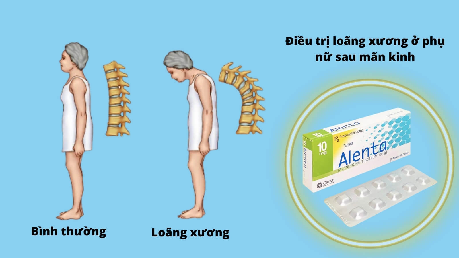 Thuốc Alenta 10 mg chỉ định điều trị loãng xương sau mãn kinh