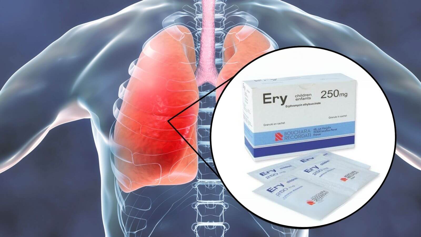 Ery 250 kìm hãm sự phát triển của vi khuẩn gây viêm phổi