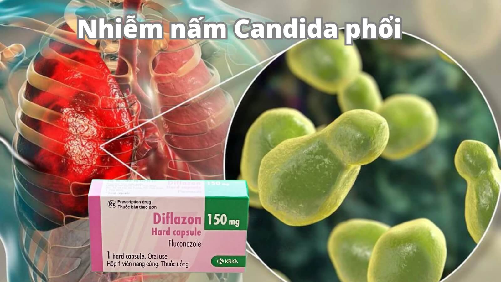 Diflazon có tác dụng điều trị nấm Cadida ở phổi