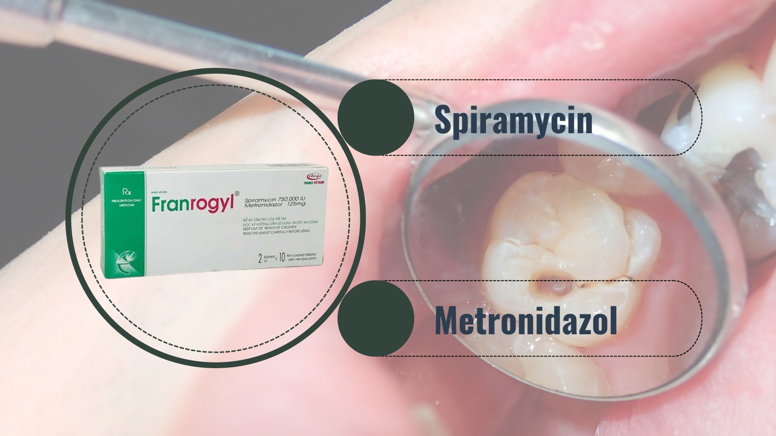 Phối hợp hai hoạt chất Spiramycin và Metronidazol làm tăng hiệu quả điều trị nhiễm khuẩn tại răng miệng