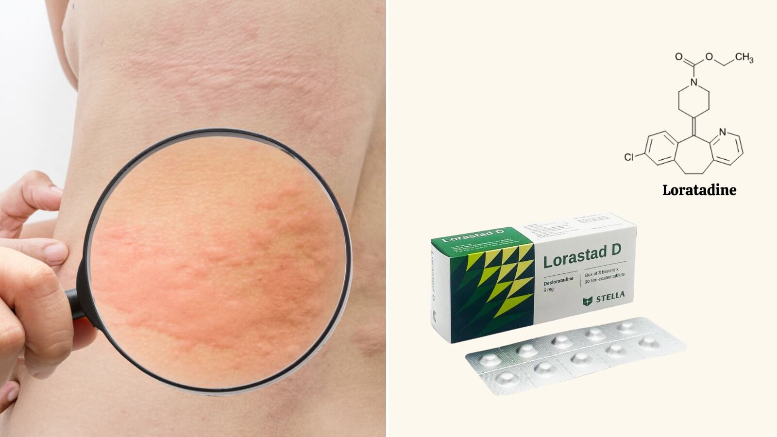 Thuốc Lorastad 10mg chứa thành phần chính là loratadine điều trị mề đay hiệu quả