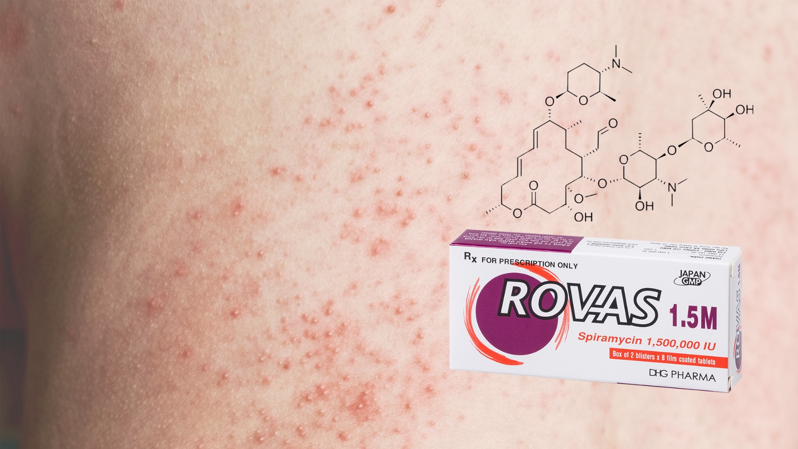 Spiramycin có trong Rovas 1.5M luôn được tin dùng trong điều trị các nhiễm khuẩn về da