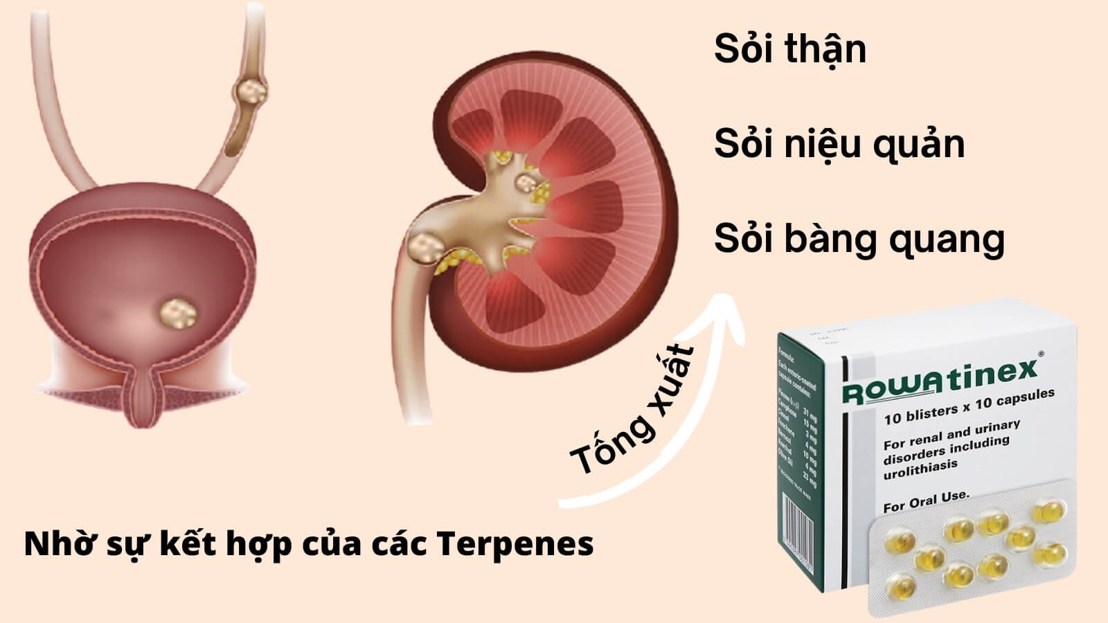 Rowatinex điều trị và dự phòng sỏi niệu - thận