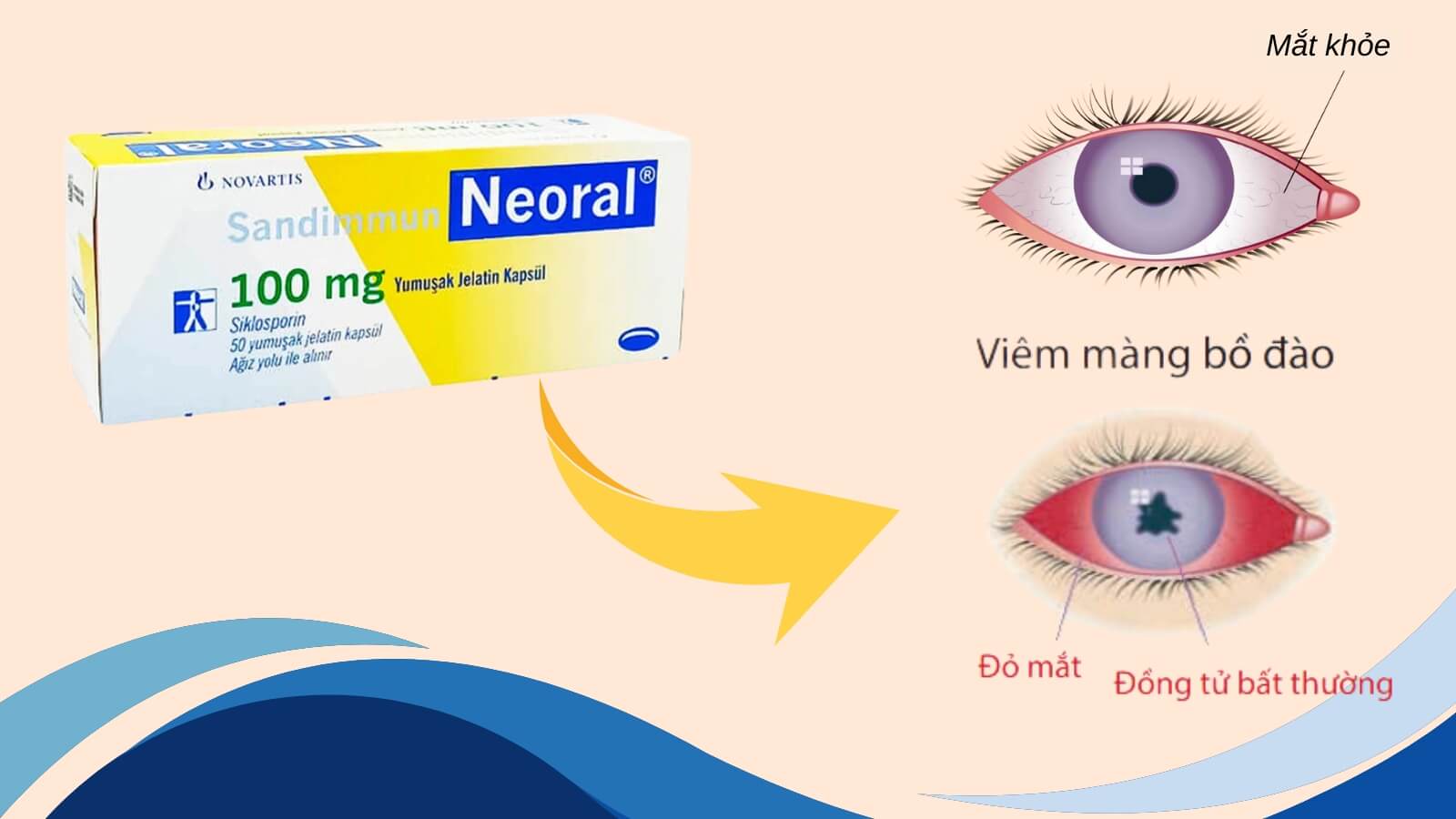 Sandimmun Neoral 100mg - Chỉ định cho điều trị viêm màng bồ đào