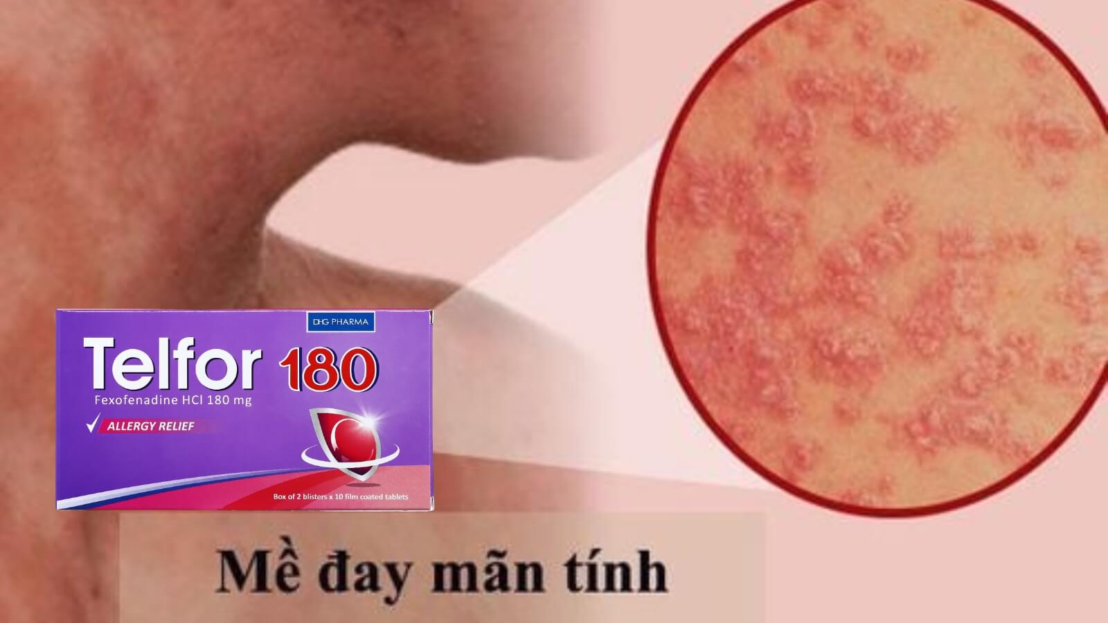 Telfor 180 điều trị mày đay mạn tính