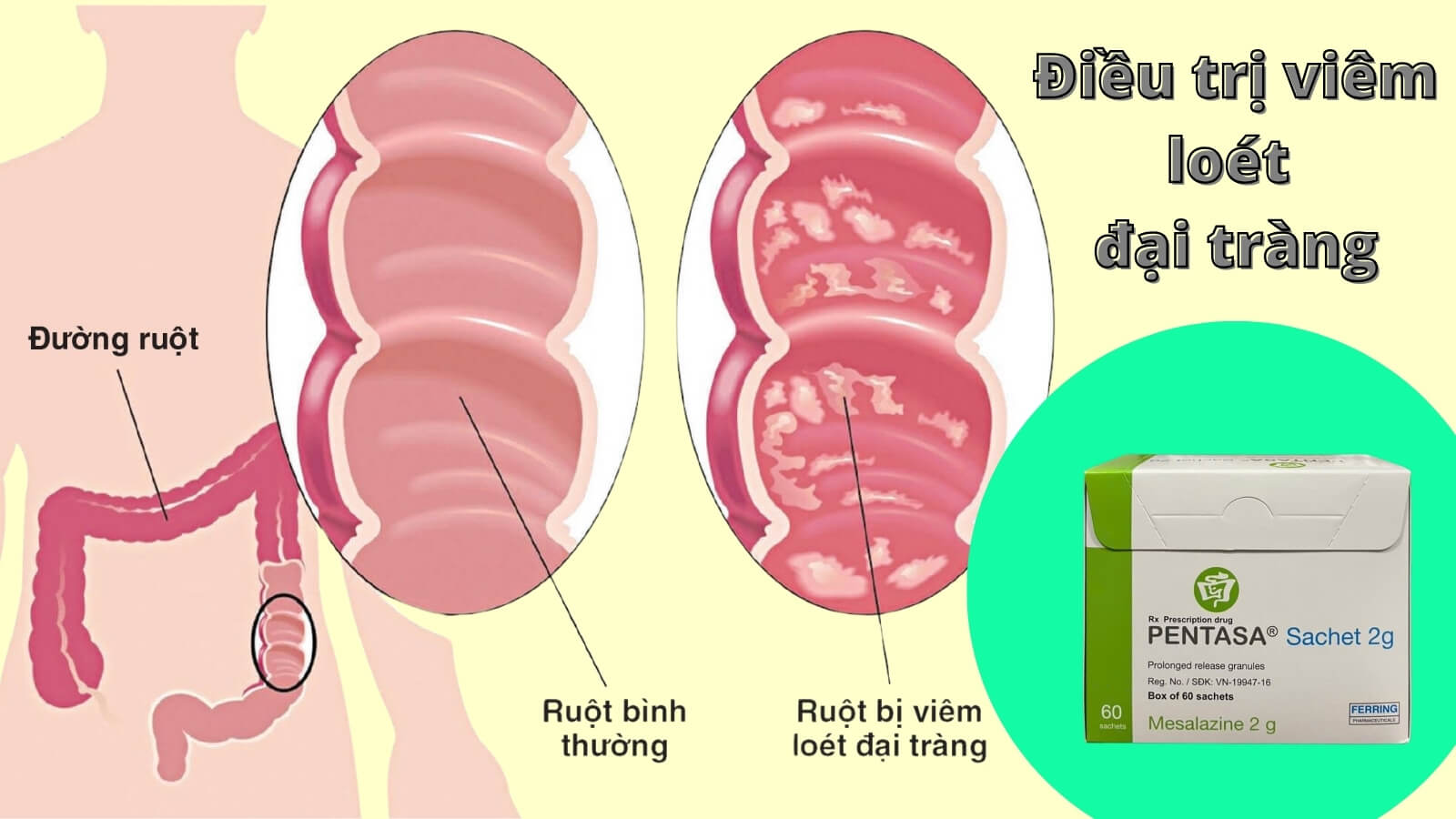 Pentasa 2g được chỉ định điều trị viêm loét đại tràng